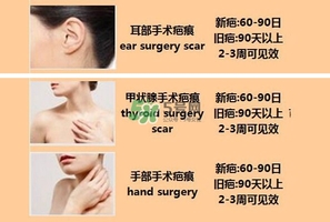 kelo cote疤痕凝膠效果好嗎？芭克硅膠軟膏效果怎樣