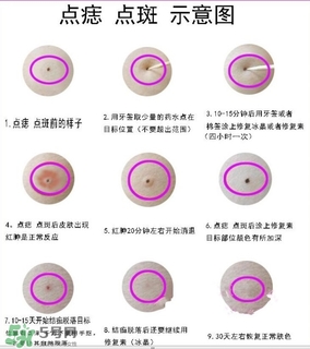 藥水點(diǎn)痣和激光點(diǎn)痣哪個(gè)好？各有什么優(yōu)缺點(diǎn)