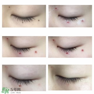 藥水點(diǎn)痣和激光點(diǎn)痣哪個(gè)好？各有什么優(yōu)缺點(diǎn)