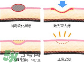 藥水點(diǎn)痣和激光點(diǎn)痣哪個(gè)好？各有什么優(yōu)缺點(diǎn)