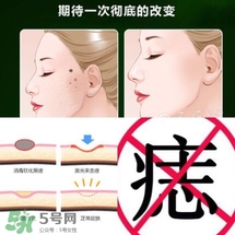 藥水點(diǎn)痣和激光點(diǎn)痣哪個(gè)好？各有什么優(yōu)缺點(diǎn)