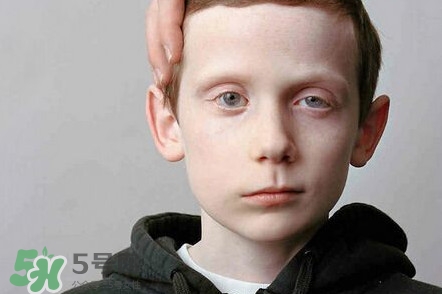 面癱是什么導(dǎo)致的？面癱多久徹底恢復(fù)正常