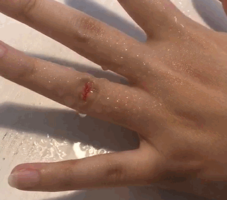 液體創(chuàng)可貼防水嗎？液體創(chuàng)可貼防水嗎透氣嗎？