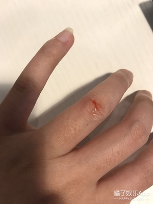 液體創(chuàng)可貼防水嗎？液體創(chuàng)可貼防水嗎透氣嗎？