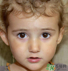 熱性驚厥的臨床表現(xiàn) 如何判斷寶寶是不是熱性驚厥？