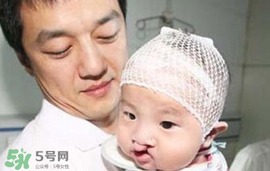 兔唇是什么？兔唇是什么原因造成的？