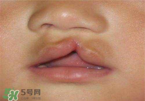 兔唇能檢查出來(lái)嗎？兔唇能完全修復(fù)嗎？