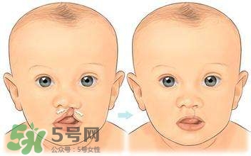 兔唇能檢查出來(lái)嗎？兔唇能完全修復(fù)嗎？