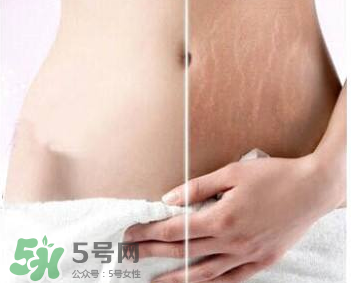 妊娠紋怎么長在大腿上了？妊娠紋會不會長在大腿上？