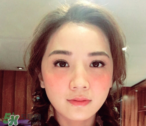 夏天可以點(diǎn)痣嗎？夏天點(diǎn)痣后要注意什么？