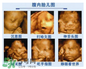 四維彩超有必要做嗎？四維彩超檢查不出什么？