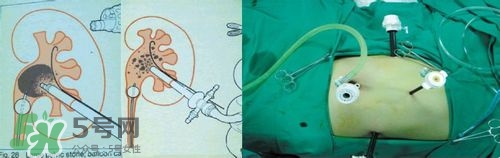 腎結(jié)石有什么癥狀？腎結(jié)石原因