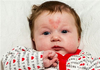 寶寶胎記是怎么來的？寶寶胎記是怎么形成的？