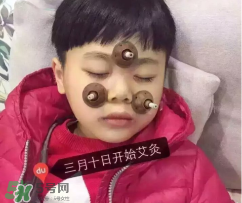 艾灸貼可以治咳嗽嗎？艾灸貼可以治退燒嗎？