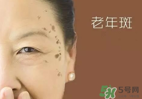 老年斑多大年齡開始有？為什么牙膏能去老年斑？