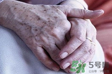 老年斑多大年齡開始有？為什么牙膏能去老年斑？