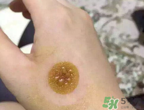 艾灸貼后有水泡怎么辦？貼艾灸貼應(yīng)注意些什么？