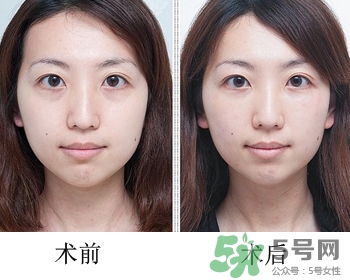 填充淚溝有風(fēng)險(xiǎn)嗎？填充淚溝的方法