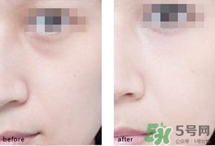 淚溝能自己恢復(fù)嗎？淚溝怎么自己恢復(fù)？