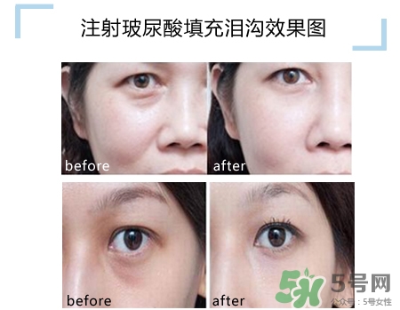 玻尿酸填充淚溝多久恢復(fù)自然？玻尿酸填充淚溝的危害