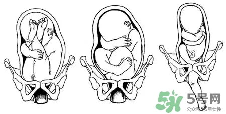 胎位不正能順產(chǎn)嗎？胎位不正怎么辦？