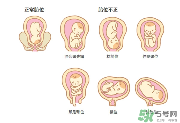 胎位不正如何矯正？胎位不正一定要剖腹產(chǎn)嗎？