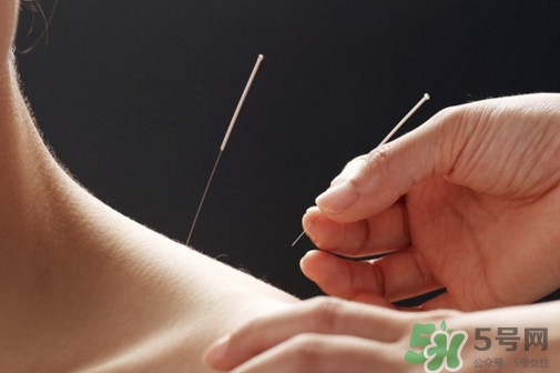 針灸可以天天扎嗎？針灸可以每天扎嗎