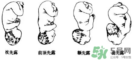 胎位不正能順產(chǎn)嗎？胎位不正怎么辦？