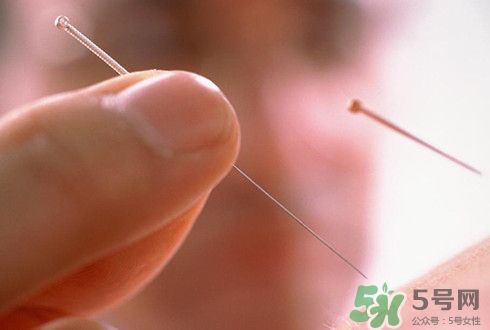 針灸可以治療失眠嗎？失眠時針灸哪些穴位有效