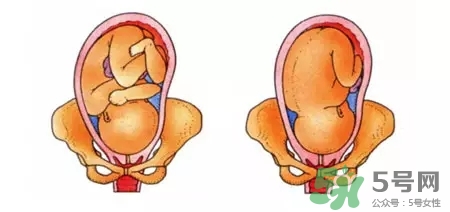 胎位不正能順產(chǎn)嗎？胎位不正怎么辦？