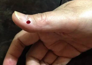 什么人不能做放血療法？放血療法有什么功效？