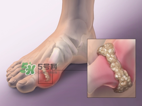 艾艾貼能治痛風(fēng)嗎？艾艾貼治風(fēng)濕嗎？