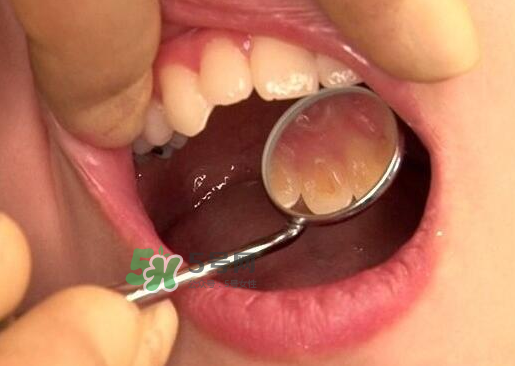 三伏天可以拔牙嗎嗎?三伏天拔牙好嗎？