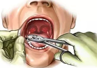 三伏天可以拔牙嗎嗎?三伏天拔牙好嗎？