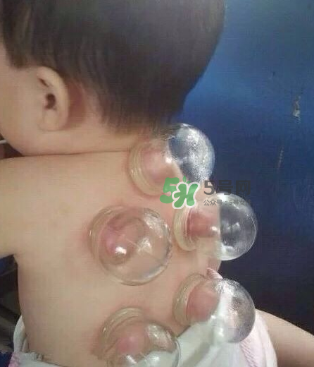 拔火罐后顏色多久消失？拔火罐印子多久能消除？