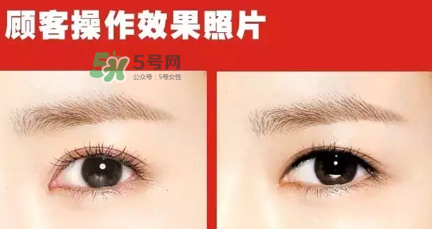 美瞳線有必要做嗎？做美瞳線多少錢(qián)？