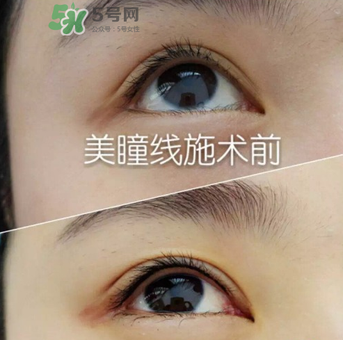 做美瞳線可以吃雞蛋嗎？做美瞳線能吃雞蛋嗎？