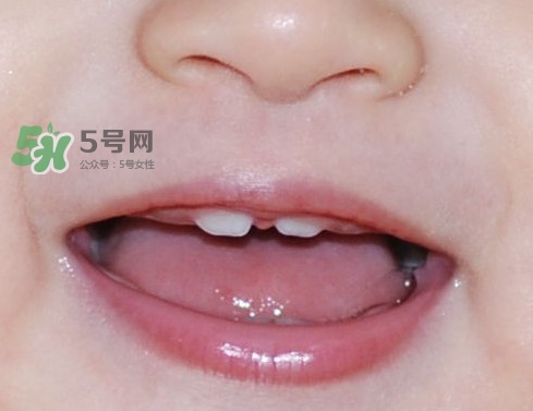 牙齒縫隙大怎么辦？牙縫大帶牙套有用嗎