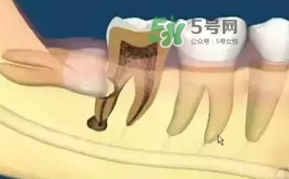 智齒是每個人都會長嗎？拔智齒能瘦臉嗎？