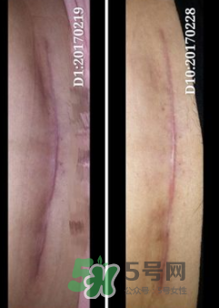Biodermis百德絲疤痕貼有效嗎？Biodermis百德絲疤痕貼好用嗎？