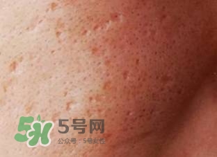 紅色痘印怎么消除 紅色痘印消除小妙招 紅色痘印怎么消除 紅色痘印消除小妙招