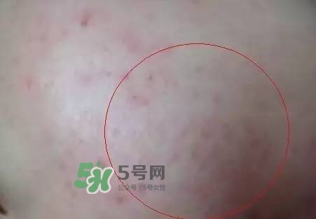 紅色痘印怎么消除 紅色痘印消除小妙招 紅色痘印怎么消除 紅色痘印消除小妙招