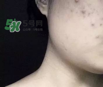 紅色痘印怎么消除 紅色痘印消除小妙招 紅色痘印怎么消除 紅色痘印消除小妙招