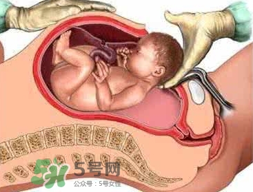 剖腹產(chǎn)比順產(chǎn)安全嗎？剖腹產(chǎn)產(chǎn)后注意事項？