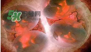 多胞胎是怎么生產(chǎn)的？多胞胎應選擇什么分娩方式