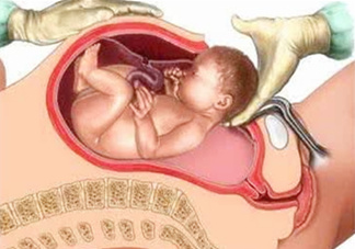 剖腹產(chǎn)比順產(chǎn)安全嗎？剖腹產(chǎn)產(chǎn)后注意事項？