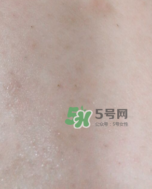 Dermatix舒痕疤痕膏有效嗎？Dermatix舒痕疤痕膏怎么用？