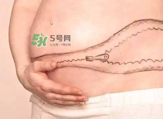 剖腹產(chǎn)疤痕怎么去除？剖腹產(chǎn)疤痕能去掉嗎？