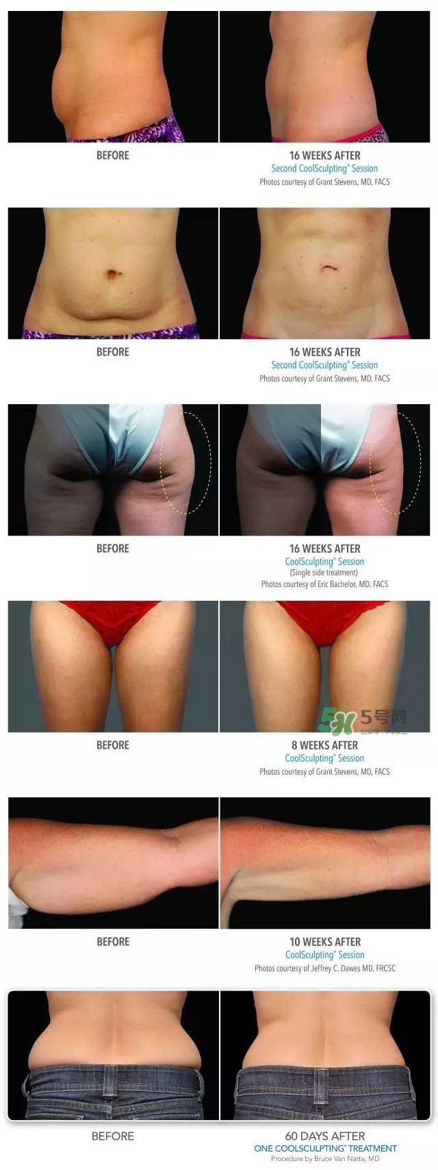 酷塑溶脂效果對(duì)比圖片 酷塑溶脂全過程記錄 酷塑溶脂效果對(duì)比圖片 酷塑溶脂全過程記錄