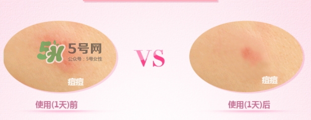 3m痘痘貼怎么用？3m痘痘貼貼多久？